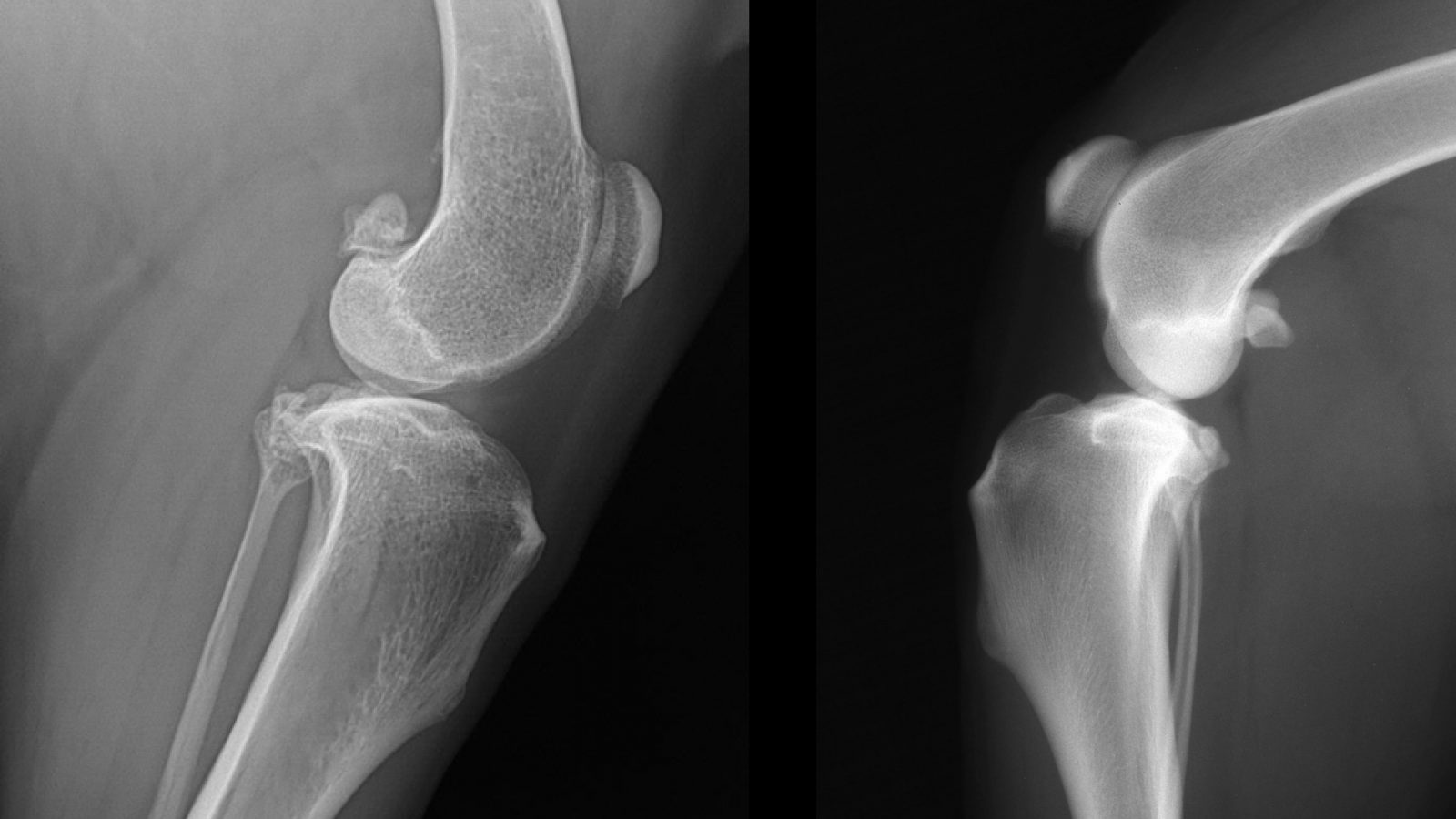 Cruciate Disease KYON