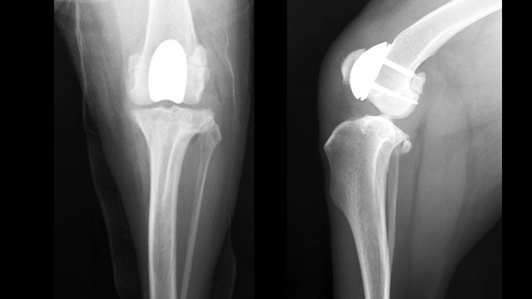 patellar groove replacement x ray