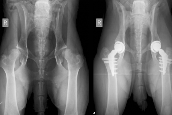 デュアルモビリティカップを備えた術前および術後の脱臼股関節